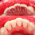 treated gums