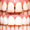 gapped teeth repaired with veneers